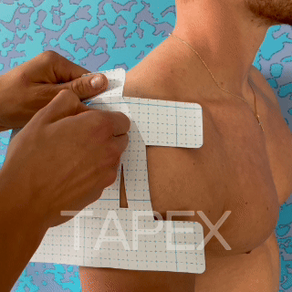 TAPEX™ - Schultergelenk